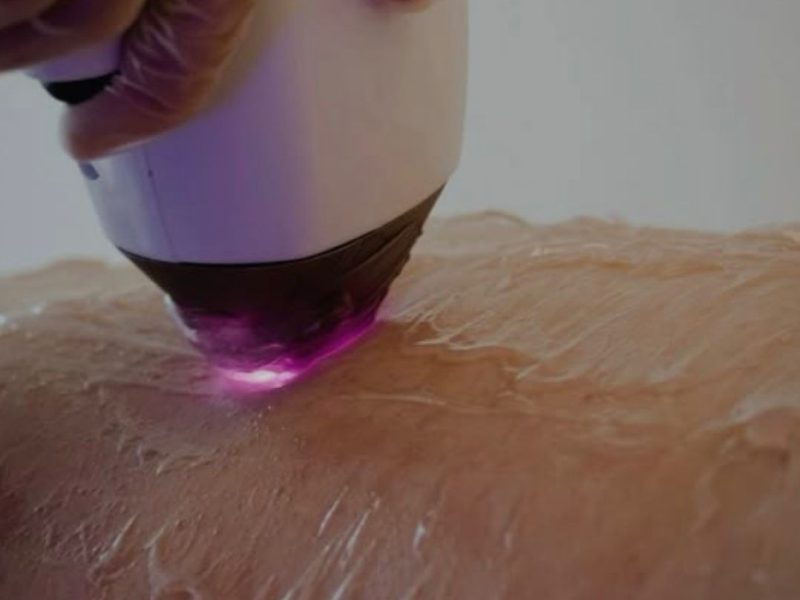 Épilation Lumière Pulsée – Corps