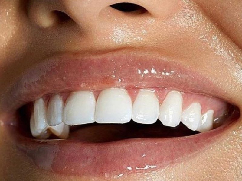 Blanchiment Dentaire Professionnel